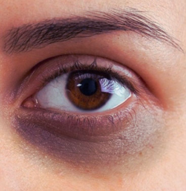 Dark Circles Dark Circles