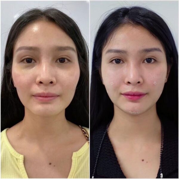 How to remove dark circles under eyes permanently